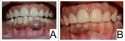 Figure 5 (A) Preoperative and (B) one-year post-operative photograph, showing a focal area of hyper-pigmentation.