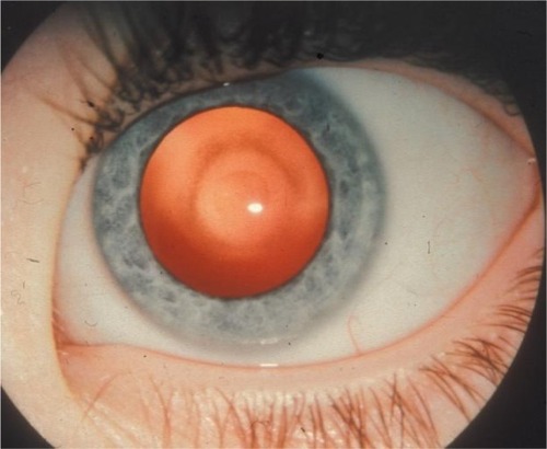 Figure 5 Oil-droplet cataract in galactosemia.