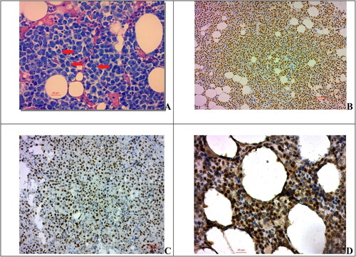 Figure 1. Expression of cyclin D1, p53 and p21 in myeloma cells. (A) Myeloma cells with plasmablastic morphology, PAS, 400×; scale bar = 20 µm; (B) Cyclin D1 nuclear expression in myeloma cells, 200×; (C) expression of p53 in myeloma cells, 200×; scale bar = 50 µm (D) protein p21 nuclear expression in myeloma cells, 400×; scale bar = 20µm.