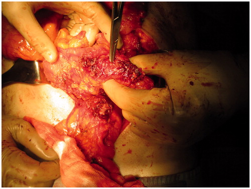Figure 4. Intraoperative view during exploratory laparotomy, showing ileal perforation ∼3 mm cause of the acute presentation.