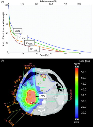 Figure 1. Dose-volume histogram (DVH) of VLiver, V’∼10%, V’∼20% and V’∼30% in patient #10 treated with FDGal PET/CT based FTP-SBRT with a total dose of 56.25 Gy in three fractions (A). The spatial distribution of FDGal (V’∼10%, V’∼20% and V’∼30%) in the liver displayed together with the dose color wash of 15 Gy (B).