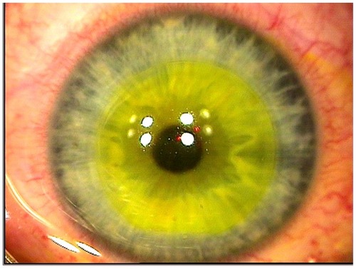 Figure 2 Flap is repositioned, and the riboflavin-yellow tinge is visualized in the corneal stroma prior to application of higher fluence ultraviolet light.