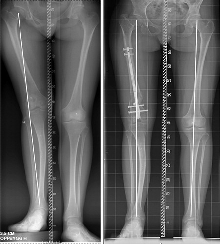 Figure 1 20-year-old woman with CFD and fibular hemimelia. Initial shortening and valgus in the femur and valgus in the tibia. Femoral valgus and shortening were corrected with the retrograde nail technique; some remaining knee valgus due to deformity in the tibia. However, acceptable mechanical axis and currently no further surgery required. High-riding trochanter, but no Trendelenburg gait.