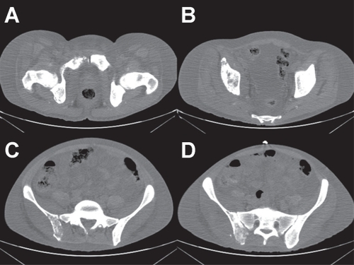 Figure 2 (A–D) Computed tomography of pelvis. These pre-treatment CT images demonstrate diffuse bony destruction with loss of normal cortical contour and trabeculations within the posterior aspect of the right ilium, right acetabulum, and right symphysis pubis.