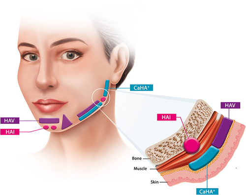 Figure 3 Possible treatment areas in the contouring plus technique (oblique view): (Radiesse® (+); Merz North America, Inc., Raleigh, NC, USA) should be performed slightly below the mandible body (blue rectangle), whereas if further definition of the mandible line is sought, a moldable HA (purple rectangle; HAV; balanced Gʹ; Belotero® Volume; Cohesive poly-densified matrix hyaluronic acid; Merz Pharmaceuticals GmbH, Frankfurt, Germany) can be injected along the mandible body in the superficial subcutaneous plane, superior to CaHA. In red, areas to be approached with a high Gʹ, Eʹ and Fn hyaluronic acid (red; HAI; Belotero® Intense; Cohesive poly-densified matrix hyaluronic acid; Merz Pharmaceuticals GmbH, Frankfurt, Germany). Round areas correspond to supraperiosteal plane of injection, whilst triangle and rectangle areas correspond to injections performed in the subcutaneous planeI.