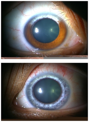 Figure 1 Photograph of the anterior segment. Heterochromia iridis is observed in the superior iris between the 10 and 2 o’clock positions in the right eye (Top). Heterochromia iridis of the entire iris of the left eye (Bottom). The patient also had mild anterior and posterior subcapsular cataract in both eyes.