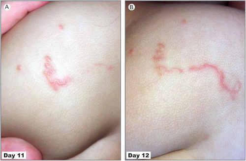 Figure 2 Characteristic skin lesions at Day 11 (A) and Day 12 (B) in 14-month-old girl.