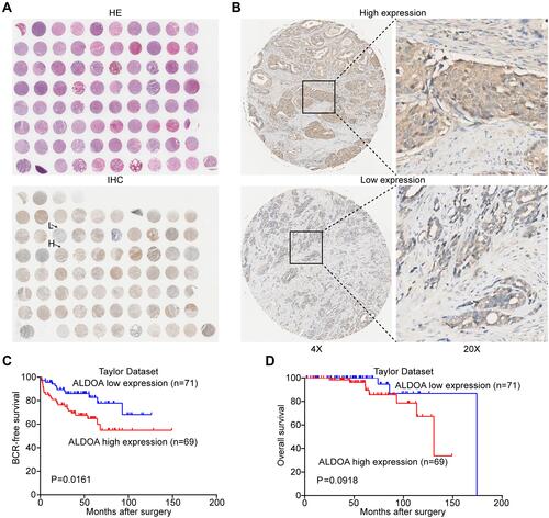 Figure 2 Immunohistochemical staining for ALDOA in PCa and adjacent benign tissues and survival analysis of ALDOA using data extracted from the Taylor database. (A) A full view of the immunohistochemistry staining for ALDOA in the TMA. (B) Immunostaining showing the high and low expression of ALDOA. Magnification on the left panel is ×4. The magnification of the right panel is ×20. (C) Kaplan–Meier curves showed that there was a significant difference in BCR-free survival between patients with high and low expression of ALDOA in the Taylor dataset (P = 0.0161). (D) There was no significant difference in overall survival between the two groups (P = 0.0918).