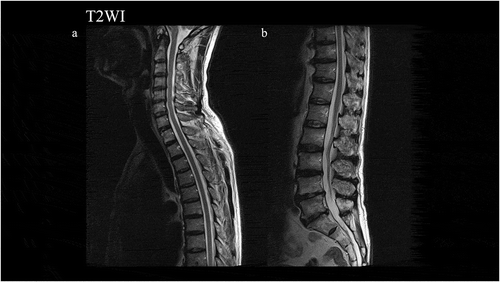 Figure 2. Magnetic resonance imaging findings in T2-weighted images (T2WI) in the spinal cord. Normal findings were observed.