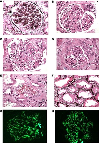 Figure 1 Microscopic finding of kidney biopsy with hematoxylin and eosin stain Periodic acid Schiff (PAS) stain, and Jones methionine silver (JMS) stain.