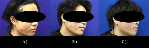 Figure 4 Various stages of treatment for Case 4. (A) Baseline; (B) 6M: Before the second treatment; (C) 8M: Treatment endpoint.
