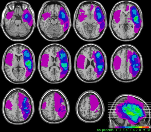 Figure 1. Lesion overlays for 10 of the 23 patients in the study, for whom scans were available. These show the foci of the lesions in frontal, parietal and temporal cortices in the right hemisphere.