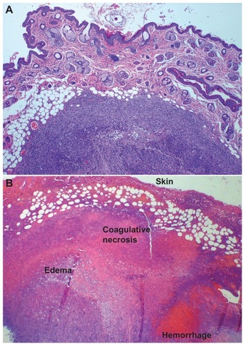 Figure 6 (A) Hematoxylin and eosin stained tumor section of a representative control/four ablations mouse, 4×. There is no evidence of thermal injury or other tissue damage; a viable tumor nodule is clearly demarcated with a healthy skin surface. (B) Hematoxylin and eosin stained tumor section of multidye theranostic nanoparticle/four ablations, 2×. Thermal injury is evident with coagulative tumor necrosis, hemorrhage, and edema in the treated tissues.