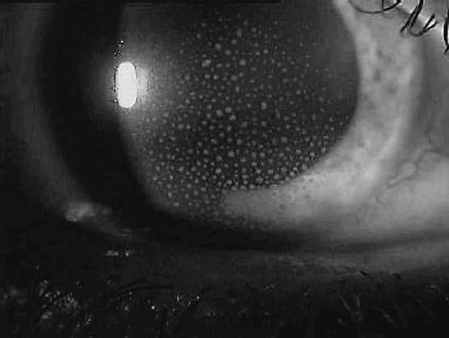 Figure 1 Anterior uveitis (iritis) with multiple keratic precipitates seen on the corneal endothelium.