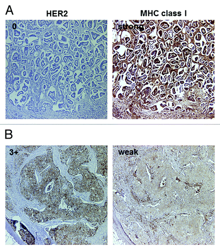 Figure 2. Representative MHC class I immunostaining of HercepTest 0 (A) and 3+ (B) cases. Serial sections were stained with antibodies specific for HER2 and MHC class I. (A) MHC class I staining was strong in HercepTest 0 case. (B) MHC class I staining was weak in HercepTest 3+ case. Original magnification: 200x.