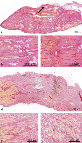Figure 5. Longitudinal cryo-sections of crush-injured soleus muscles stained with Picrosirius red. a. Overview showing the angular uninjured region at the middle of the section (from day 1 after injury). The insertion of the neurovascular bundle is indicated by an arrow. b. Detail of panel a showing ruptured myofibers as evidence of shearing-type injury. c. Detail of panel a showing swollen, prenecrotic myofibers as evidence of in situ necrosis happening in parallel to the latter type of injury. d. Overview of the uninjured zone and the distal crush zone of a soleus muscle from day 2 after crush injury. e. Detail of panel d showing the border zone of injured and uninjured muscle with an interstitial inflammatory reaction. f. Myofibers in the crush zone surrounded by inflammatory cells in loose connective tissue.