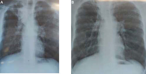 Figure 1 Plain film chest radiographs for patient one - Postero-Anterior view: (A) June 2020, showing bilateral upper lobe infiltration and right upper lobe cavity and right paratracheal hilar lymphadenopathy, (B) October 2020, showing bilateral upper lobe fibrosis and a residual cavity in left upper lobe.