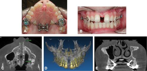 Figure 8 Patient records after maxillary expansion. (A) Intraoral occlusal picture. (B) Intraoral frontal picture. (C) CBCT axial palatal section. (D) 3D rendering of maxilla. (E) CBCT coronal section through the 2 additional lateral miniscrews.