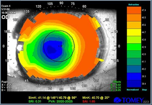 Figure 2 Right eye videokeratography maps of 35 yrs old female patient, originally treated with an unknown excimer laser using a standard PRK. Preoperative MRSE was −6.50 D with a DCVA of 20/20. Eight months after PRK, the refractive error was +2.00sph (DCVA 20/25), with a 1.2mm decentration of the photoablation.