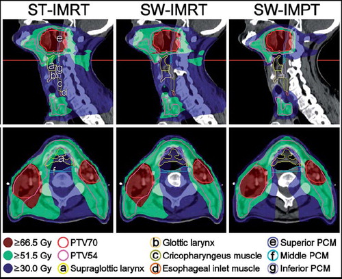 Figure 1. Sagittal and axial representation of dose distributions with standard (ST)-intensity-modulated radiotherapy (IMRT), swallowing-sparing (SW)-IMRT and 7-beam SW-intensity-modulated proton therapy (IMPT) in a sample patient.