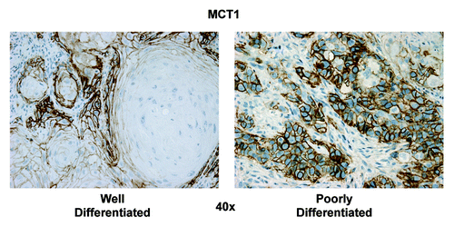 Figure 7. Higher power views of MCT1 immunostaining in HNSCC specimens. As in Figure 5, except higher power view are shown to better appreciate the plasma membrane staining of MCT1+ tumor cells. Also, note that MCT1 staining is absent from the the tumor stroma and cancer-associated fibroblasts. Original magnification: 40×, as indicated.