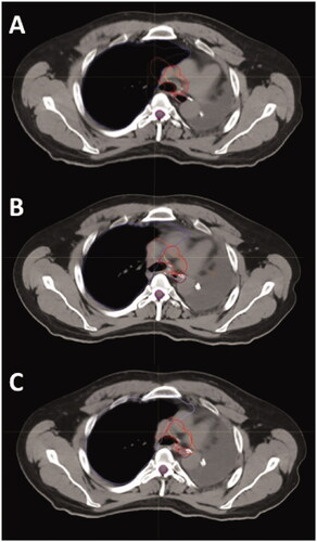 Figure 1. A representative transverse slice of the CT scans acquired on 25th August (A; least pleural effusion), 8th September (B; most pleural effusion) and 2nd October (C; intermediate level of pleural effusion), which served as basis for treatment plans R1/R2A, R2C and R2B, respectively. The deviation of the contours of right lung (purple), CTV elective (red) and CTV boost (orange) with varying positions of the mediastinum can be appreciated.