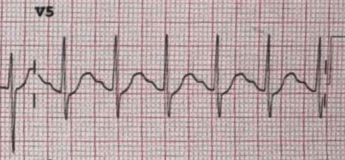 Figure 1 The electrocardiogram prior to antiarrhythmic treatment. The electrocardiogram shows a short PR interval, a delta wave, wide QRS complex, and ST depression.