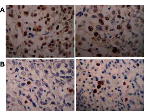 Figure 6 (A and B) Histology of apoptosis and proliferation in nude mice renal cell carcinoma xenografts from adenovirus human telomerase reverse-transcriptase herpes simplex virus thymidine kinase/ganciclovir (Ad-hTERT-HSV-TK-GCV)-infected or control mice. (A) Histology of apoptosis cells from Ad-hTERT-HSV-TK-GCV-infected (left panel) or control mice by terminal deoxynucleotidyl transferase dUTP nick-end labeling (right panel). (B) Histology of proliferative cells from Ad-hTERT-HSV-TK-GCV-infected (left panel) or control mice by nuclear antibody staining (right panel).