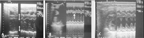 Figure 3 BM-mode echocardiography of seropositive dogs to Trypanosoma cruzi, in the Malinalco village, State of Mexico. (A) Increased thickness of the interventricular septum and left ventricular wall; (B) asynchronic interventricular septum motility; (C) normal.