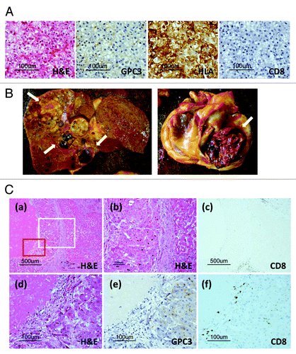 Figure 2. (A) Pathological findings of liver biopsy specimens before vaccination. A microscopy image of a hematoxylin and eosin (H&E)-stained section shows well-differentiated hepatocellular carcinoma (HCC). Immunohistochemical staining for GPC3 and HLA class I showed positivity in the cytoplasm and membranes of carcinoma cells, respectively. No CD8-positive T cells were observed in carcinoma tissue before vaccination. (B) Macroscopic findings of the liver and heart before formalin fixation at the time of autopsy. Most liver tumors had a necrotic area (arrow). A tumor thrombus occupied most of the right atrium (arrow). (C) Pathological findings of the autopsy specimen. (a) Microscopic images of H&E-stained sections showing central necrosis of carcinoma tissue, whereas a cirrhotic nodule adjacent to the carcinoma tissue was not necrotic. (b) Magnified image of the area enclosed within the white box in (a) showing that cancer cells exhibited a morphology (left) different from that of cirrhotic cells (right). (c) CD8-positive T cells (brown) infiltrated the carcinoma cells accompanied by necrosis. In contrast, no infiltration of CD8-positive T cells was detected within the cirrhotic nodule. (d) Magnified image of the area enclosed within the red box in (a) showing necrosis and viable carcinoma cells. (e) Positive immunohistochemical GPC3 staining was observed in only the cytoplasm of carcinoma cells. (f) CD8-positive T cells infiltrated the necrotic area and carcinoma tissue.