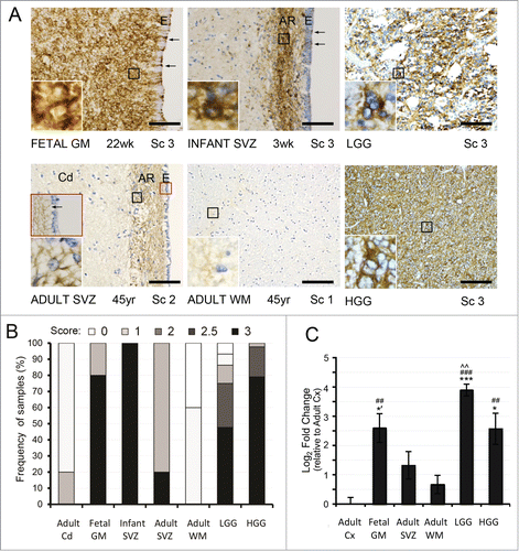 Figure 1. EGFR expression analysis in the developing and adult human SVZ and in gliomas. (A, B) Immunohistochemical (IHC) analysis of EGFR expression in non-neoplastic tissues reveals strong immunoreactivity throughout the fetal germinal matrix (GM) (score (Sc) 3 in 80%) and infant subventricular zone (SVZ) where it localizes to the astrocytic ribbon (AR) (Sc of 3 in 100%). In the adult SVZ, moderate band-like immunoreactivity is seen throughout the AR, with strongly positive membranous staining around some cells within it (inset). In the adult white matter (WM), only rare, weakly stainined cytoplasmic processes are visible, typically in association with blood vessels. Ependymal cell layer (E) indicates the beginning of the GM/ SVZ. Traversing EGFR-positive processes between the astrocytic ribbon and the ependymal surface are noted as arrows. In gliomas, both LGG and HGG show strong immunoreactivity for EGFR (Sc of 3 in ∼50% and ∼80%, respectively). Scale bar = 100 μM (20X objective). Distribution of EGFR protein expression is evaluated by semiquantitative IHC scoring as previously defined.Citation19 The presence of membraneous and cytoplasmic staining is scored on a scale from 0 (no staining) to 3 (strong staining) in adult Cd (n = 5), fetal GM (n = 5), infant SVZ at AR (n = 6), adult SVZ at AR (n = 5), adult WM (n = 5), LGG (n = 44), and HGG (n = 43). (C) The changes of EGFR mRNA expression parallel those for its protein, with significantly higher levels of EGFR in fetal GM, LGG gliomas, and HGG gliomas, compared to adult Cx and adult WM. EGFR mRNA levels are expressed as average Log2 fold change over Cx ± SE, with statistical significance relative to adult Cx (##P < 0.01; ### P < 0.001), adult WM (*P < 0.05; *** P < 0.001; one-tailed t test: *’ P < 0.05), and adult SVZ (^^P < 0.01).