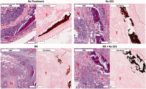 Figure 7. Patterns of necrosis following treatment showing Ra-223 enhances necrosis proximal to regions of calcification. Histology of C4-2B–BMP4 tumors (T) 1 week after treatment shows higher necrosis (N) in regions immediately proximal to sites of calcification (C) when treated with Ra-223. Necrosis in IRE-treated tumors shows more necrosis toward the center of tumor with more viable cells toward the tumor boundary (demarcated by dashed red line). Similar to Ra-223 alone, IRE plus Ra-223 shows enhancement of necrosis adjacent to sites of calcification.