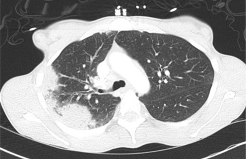 Figure 3 CT axial view in the same patient demonstrating the right-sided pleural based consolidation.