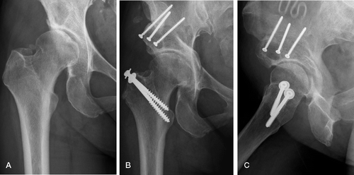 Figure 1. 46-year-old woman who had a right painful dysplastic hip (A). 2 years after PAO showing solid bony union and good joint congruity (B). The lateral projection shows that the osteotomy was spherical in shape and that the femoral head was well covered anteriorly (C).