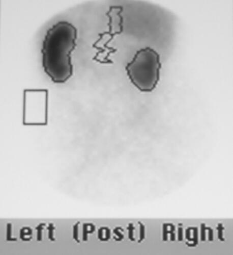 Figure 7 MAG 3 of a 64-year-old lady with XGP in the upper pole of a duplex right kidney, showing loss of function in the affected pole, but with preserved function in the lower pole moiety, the latter accounting for 38% of total renal function. Subsequent management was directed at preserving the lower pole and managing the complications relating to the upper pole. These goals were achieved using antibiotics and percutaneous interventions only.