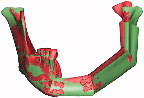 Figure 5. The right mandibular regions were registered to compare data from two images. A comparison is shown between the surgical simulation (red) result and the postoperative result (green).