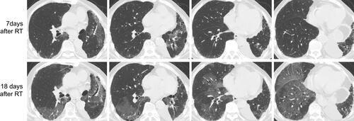 Figure 1 The CT images of patient No. 1 during the course of fatal RP.