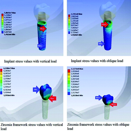 Figure 2. Stress analysis of the mandibular implant-supported crown.