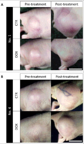 Figure 2. Treated and untreated PDOX tumors. Tumors from USTS PDOX models of patients 1 and 4 are shown before and after treatment with DOX. Scale bar: 5 mm.