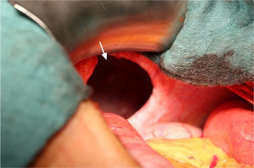 Figure 3 Huge hernial gap in the diaphragm.