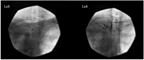 Figure 2 Left-sided T2 sympathetic neurolysis. On the left side, an antero-posterior view of the fluoroscopically guided procedure to place the tip of a 22G spinal needle onto the ventrolateral aspect of the T2 vertebral body. On the right side, an injection of 1mL of contrast media confirmed the lack of spread into intra-spinal structure and intravascular uptake. 3mL of 0.25% bupivacaine and 3mL of 8% phenol were injected.