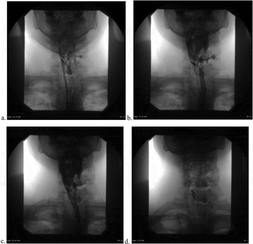 Figure 3a. (ad). Post-endoscopy single contrast esophagram. Anterior Views with attention to the neck initially with Gastrografin and then thin barium. 3D is a static image during phonation