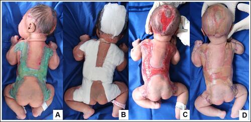 Figure 2 WD used on the patient. Initially, lesions were treated with Sorbact® gel dressing-BSN Medical and then covered with sterile gauze (A and B), after the gelatinous-shiny-membrane disappeared (C) hydrocolloid WD was used until complete epithelialization was achieved (D).