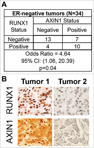 Figure 1. Association between RUNX1 and AXIN1 in ER− breast cancer tumors. Breast cancer tumor microarray TMA-1007 from Protein Biotechnologies, Inc. was immunostained for RUNX1 and AXIN1. The ER− invasive ductal carcinomas were designated as positive or negative for RUNX1 and AXIN1. (A) RUNX1 and AXIN1 status, and the odds ratio and 95% confidence intervals for the association between AXIN1 status and RUNX1 status in the ER− tumors in the TMA. Association between the RUNX1 status and AXIN1 status was tested using the Pearson chi-square test for the 2 × 2 table. (B) RUNX1 and AXIN1 immunohistochemical staining of 2 representative ER− tumors from the TMA illustrating the association between RUNX1 and AXIN1 expression.