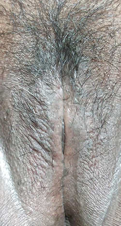 Figure 4 Clinical improvement was observed as the lesion became hyperpigmented macules without itching in the four weeks of follow-up.
