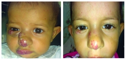 Figure 2 Multiple facial hemangiomata prior to and 6 months after treatment.