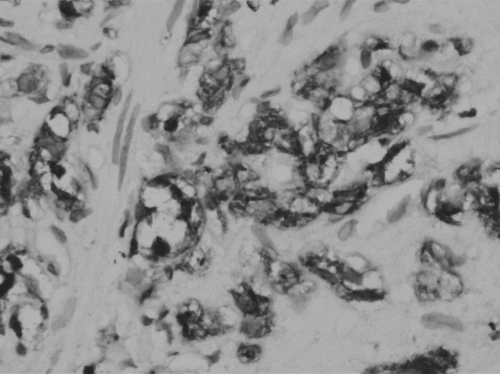 Figure 1 Expression of hTERT in PCa (SP, × 400) Staining intensity was detected in the cytoplasm of tumor cells.