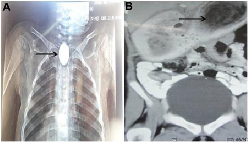 Figure 3 X-ray was used to localize the foreign body (coin; arrow) in some cases (A), and computed tomography (B) was used to describe the huge gastric bezoar (arrow) in the case of a mentally disabled patient.