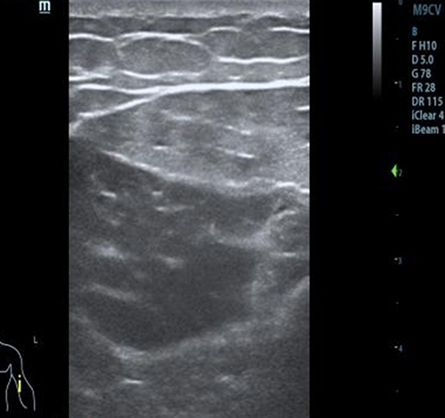 Figure 3 Ultrasound screenshot of upper limb muscles.