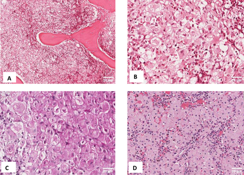 Figure 3 (A) Low power Images of the trephine biopsy showing a hypercellular marrow (100% cellularity) with numerous large cells with abundant pink cytoplasm crowding out all the hematopoietic cells. (B) high power view (x400) of the same marrow showing Gaucher cells with wrinkled tissue paper cytoplasm. (C) High power view of the trephine biopsy showing Gaucher cells weakly positive for periodic acid Schiff (PAS). (D) Histology section of the spleen showing sheets of macrophages (Gaucher cells) with abundant amphophilic cytoplasm and scattered residual lymphocytes.